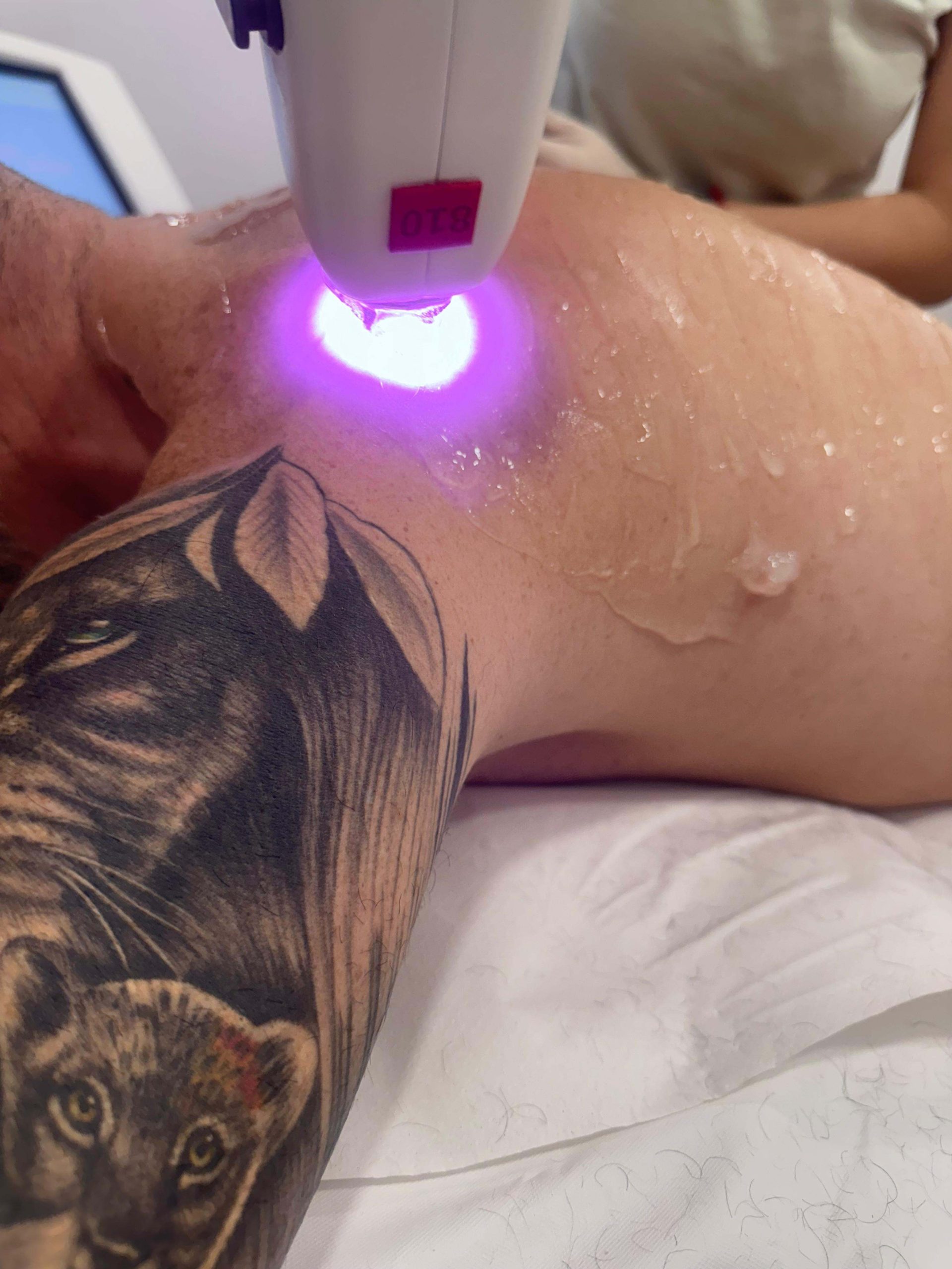 DEPILACIÓN LASER PECHO, ESPALDA Y AXILAS